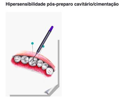 Hipersensibilidade Dentária