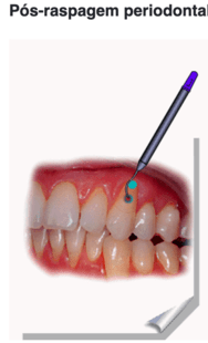 Pós raspagem periodontal 