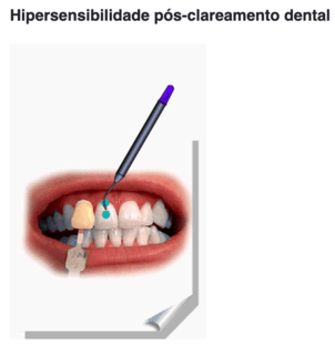 Hipersensibilidade pós clareamento dental