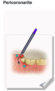 Pericoronarite
