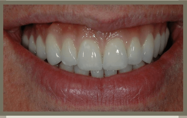 Prótese  sobre-implante com dentes e gengiva em porcelana